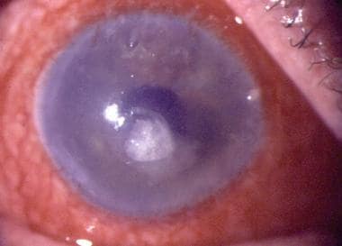 Secondary corneal ulcer in a case of acute hemorrh