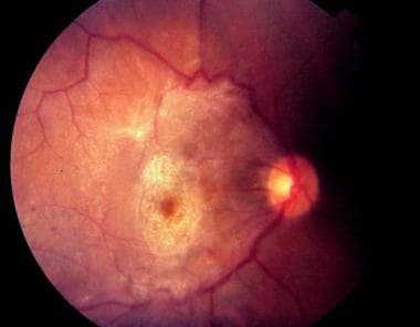 Very dense epiretinal membrane with associated mac