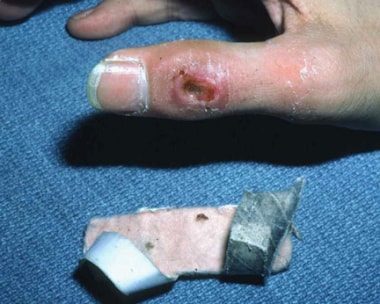 Pressure injury can result from splint that is app