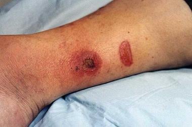 Burns complicated by cellulitis. The larger lesion