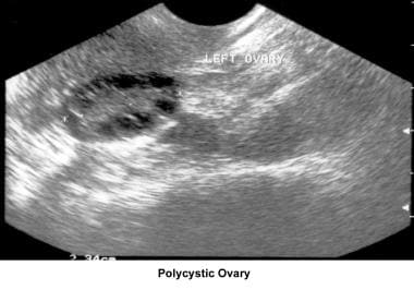 Anovulation. Polycystic ovary. Courtesy of Jairo E