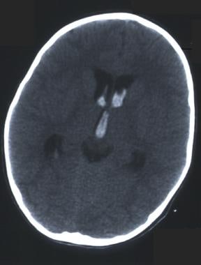 CT scan without contrast in the patient with fourt