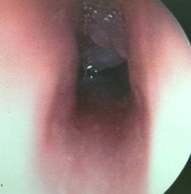 A subglottic endoscopic view of granulation tissue