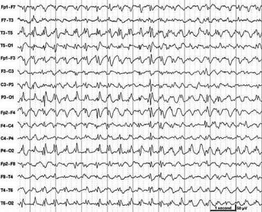 Slow spike-and-wave discharges (2.5 Hz). This is a