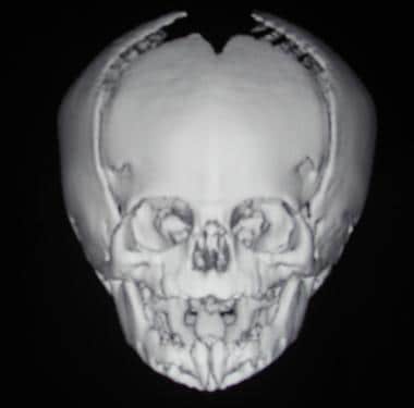 Craniosynostosis management. A child with metopic 