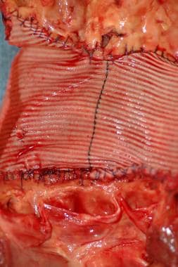 Implanted vascular graft material used to replace