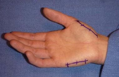 Locations for thenar incision over radial aspect o