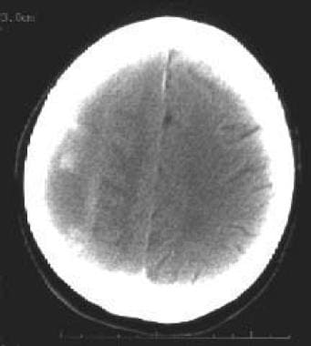 Isodense subdural hematoma (SDH). Note that no sul