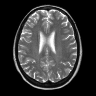 This T2-weighted axial MRI does not demonstrate we