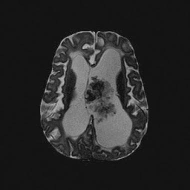 Axial T2-weighted magnetic resonance image (repeti