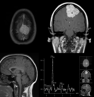 MRI with the following sequences: axial T1 post ga