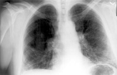Chest radiograph in a patient with chronic hyperse