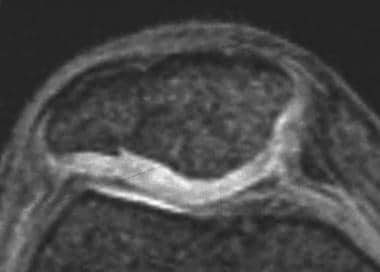 Magnetic resonance image of a healed patellar frac