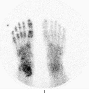Reflex sympathetic dystrophy of the foot. Delayed 