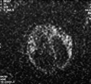 Axial diffusion-weighted magnetic resonance image 