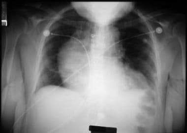 Chest radiograph showing widening of the superior 