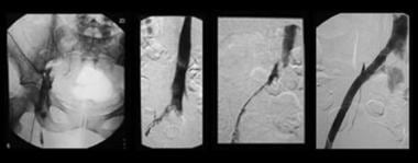 Sequential images show treatment of iliofemoral de