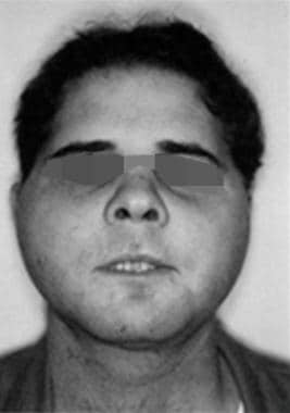 LeFort III fracture showing facial flattening, wid