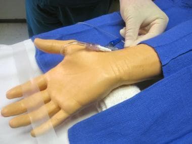 Radial artery cannulation (catheter over needle).