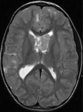 Subependymal giant cell astrocytoma prior to stere