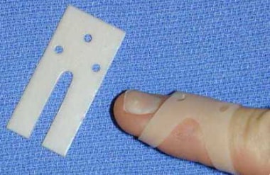 Thermoplastic blank for custom-molded mallet finge