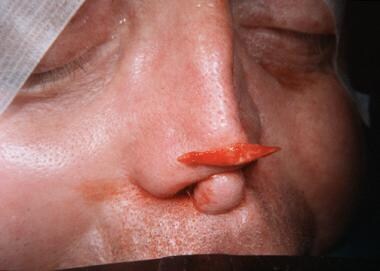 Calvarial bone graft and auricular conchal cartila