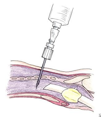 Percutaneous dilational tracheotomy (PDT technique