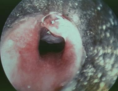 Intraoperative suspended view through a subglottos