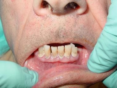 A 72-year-old man with severe periodontal disease.