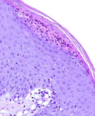 Guttate psoriasis. A Munro microabscess is present