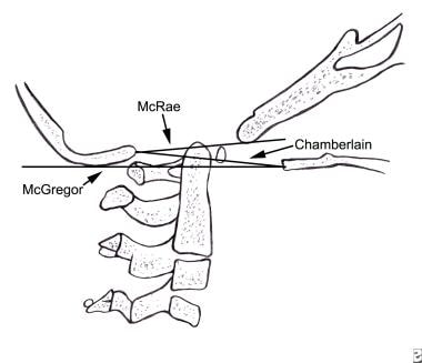 Lateral craniotomy. Drawing indicates three lines 