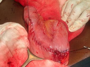 Third layer of gastrojejunostomy completed with co