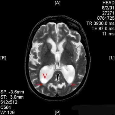 Axial T2-weighted magnetic resonance image of the 