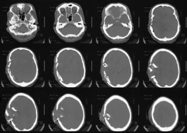 Axial brain and bone-window computed tomography sc
