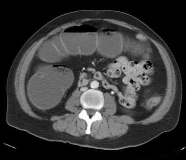 An 82-year-old patient presented with vomiting and