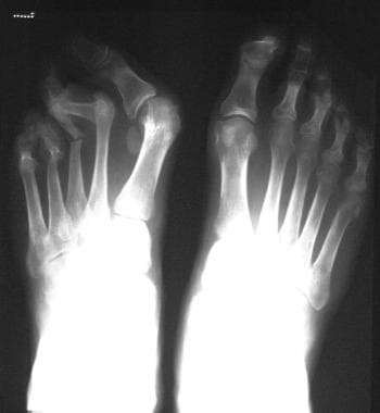 Reactive arthritis. Radiograph of the feet in a 27