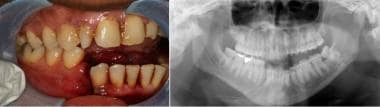 Mandibular fracture. Courtesy of Arthur K. Adamo, 