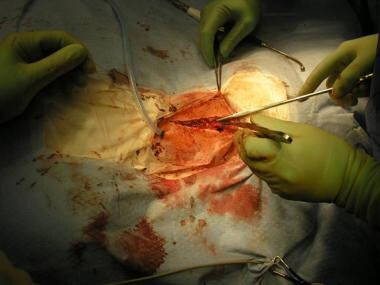 Only deep layer to be approximated is platysma. Pl