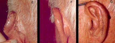 Bilobed transposition flap. Panels E and F: Immedi