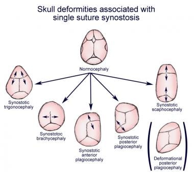 suture skull deformities craniosynostosis single synostosis pediatric associated