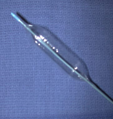 Modified angioplasty catheter used in creation of