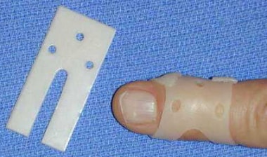 Dorsal view of custom-molded thermoplastic splint 