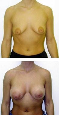 (Above) Preoperative view of 26-year-old woman wit