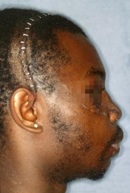 Postoperative profile view of patient, demonstrati