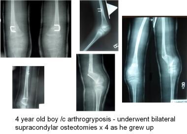 Starting at age 4 years, this patient subsequently