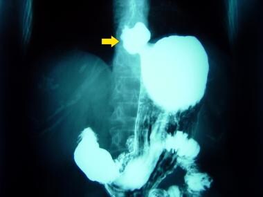 Gastroesophageal Reflux Disease. This radiograph s