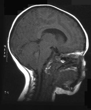 T1-weighted MRI. Rare case of a fourth ventricle e