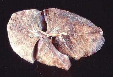 Gross pathology of advanced emphysema. Large bulla
