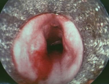 Postexcision view of granulation tissue through th