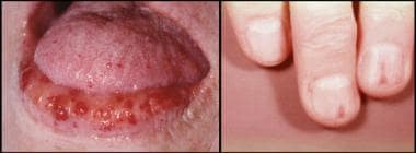 Hereditary hemorrhagic telangiectasia. Photographs